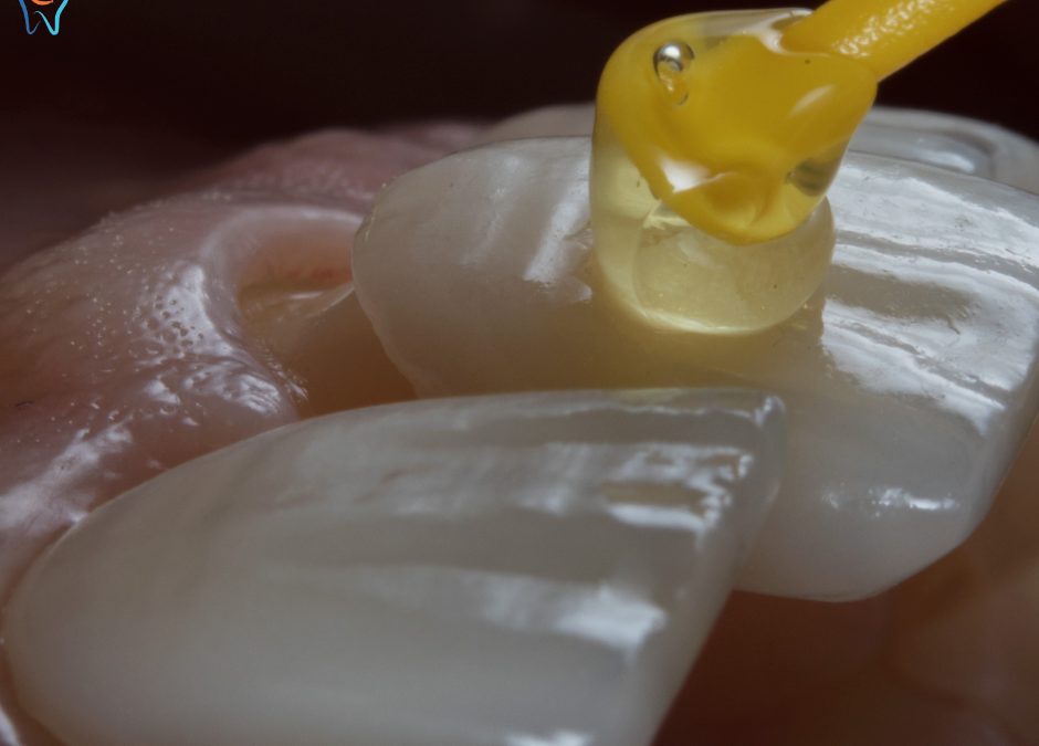 Le Faccette Dentali: Trasforma il Tuo Sorriso con una Soluzione Rapida ed Efficace