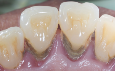 Parodontite: i rimedi casalinghi più pericolosi e gli errori che peggiorano l’infiammazione gengivale