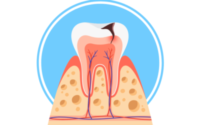 Incappucciamento della Polpa Dentale: Cos’è e Quando Serve