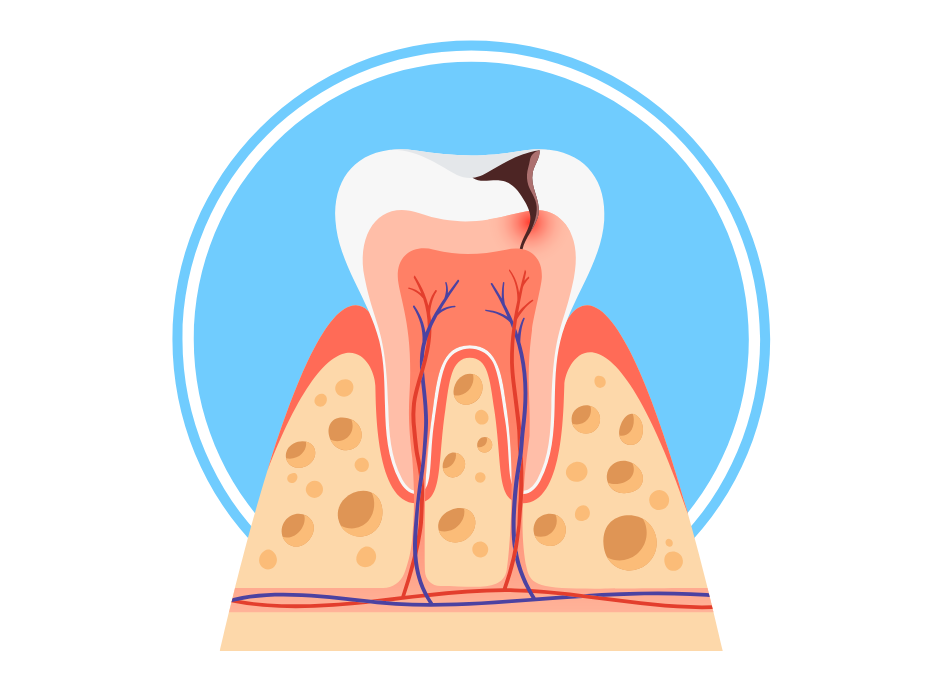 Incappucciamento della Polpa Dentale: Cos’è e Quando Serve