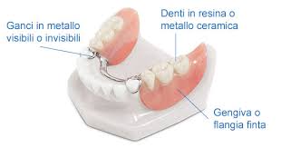 Protesi Scheletrata: Una Soluzione Efficace e Stabile per Sorridere di Nuovo