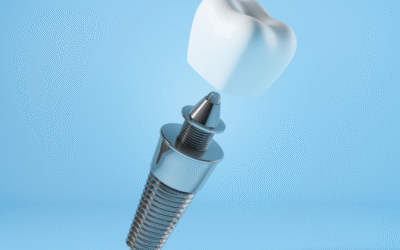 Protesi su impianti: comfort, stabilità e un sorriso naturale