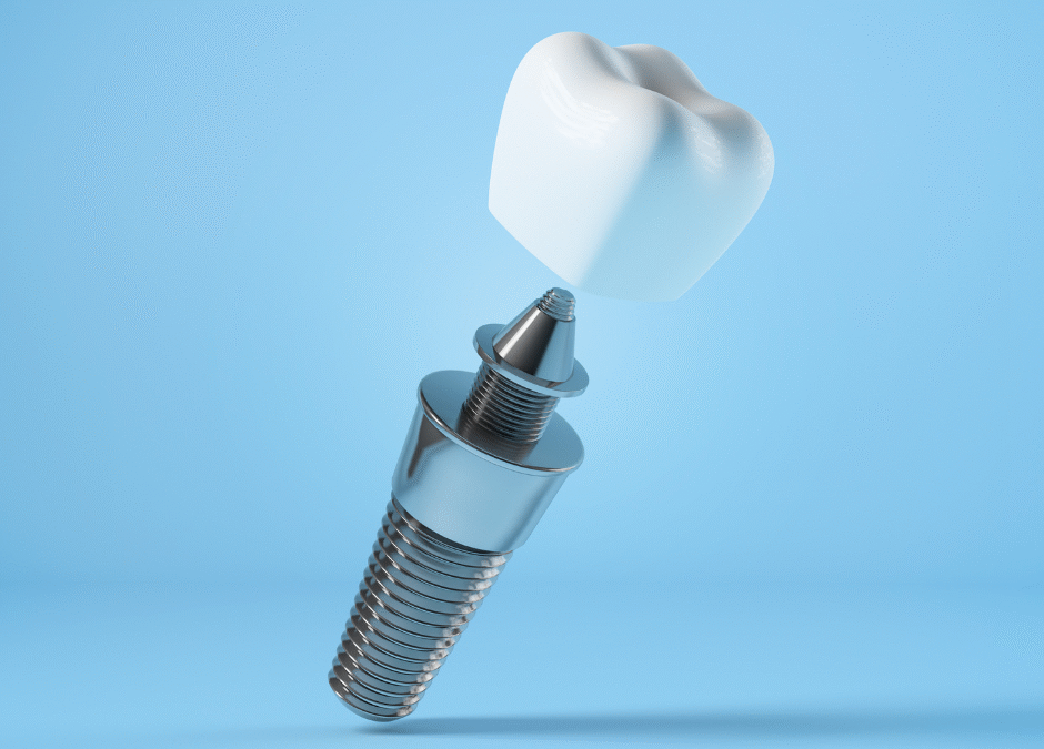 Protesi su impianti: comfort, stabilità e un sorriso naturale