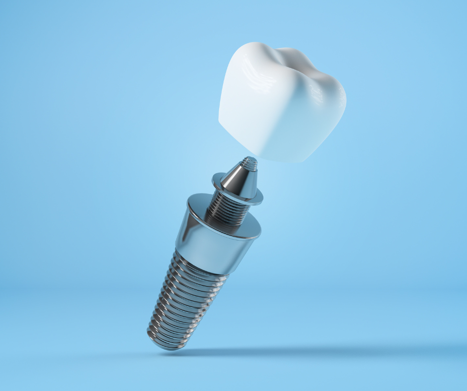 Pianificazione chirurgica computer guidata per impianti dentali su arcata completa