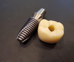 Riabilitazione protesica su impianti per comfort e funzionalità masticatoria ottimali.