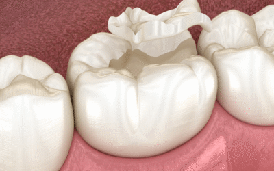 Intarsio dentale: cos’è e quando è la soluzione ideale