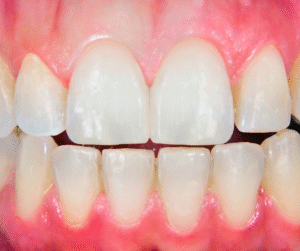 faccette dentali per correggere forma e colore dei denti anteriori