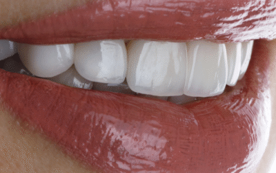 Faccette dentali: come migliorare il sorriso in modo naturale