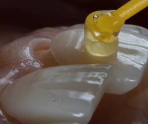 faccette dentali per correggere forma e colore dei denti anteriori