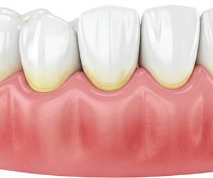 Effetti del fumo sulla salute delle gengive e sviluppo della parodontite"