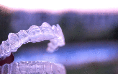 Allineatori trasparenti: la soluzione discreta per allineare i denti a ogni età