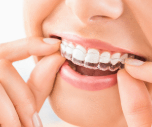 Allineatori trasparenti rimovibili posizionati su arcata dentale