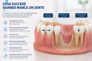 dente mancante con spostamento dei denti vicini e perdita di osso nel tempo
