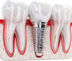impianti dentali 